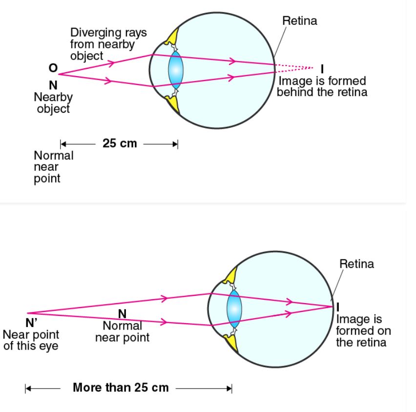 a-what-is-long-sightedness-state-the-two-causes-of-long-sightedness