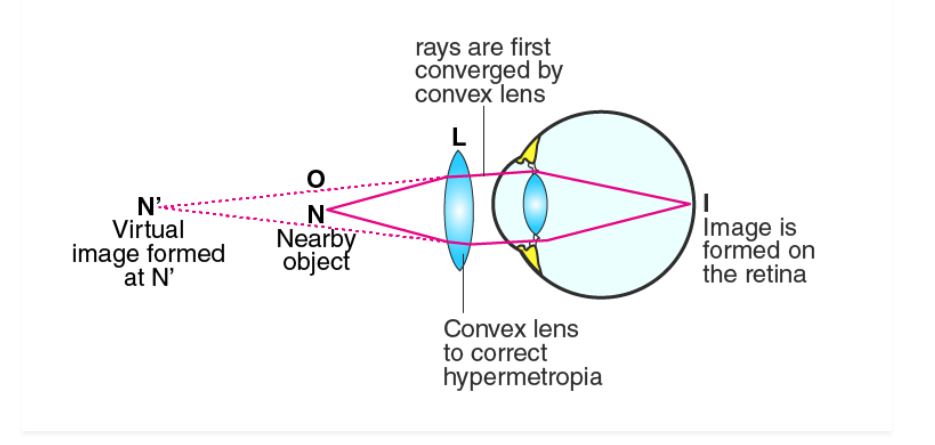 Explain With The Help Of A Labelled Ray Diagram The Defect Of Vision Called Hypermetropia And